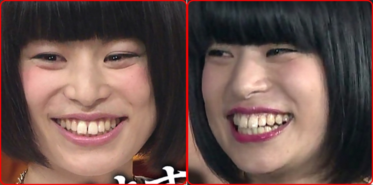 さとうほなみ(ほないこか)の歯並びは矯正？過去と現在の画像を比較！